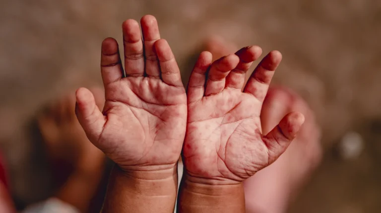 How to Treat Hand, Foot, and Mouth Disease at Home